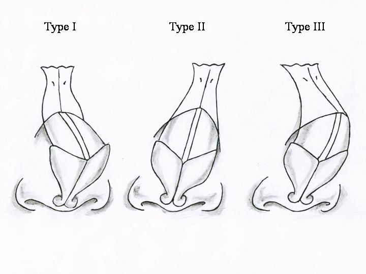 鼻扭曲可分類三種類型